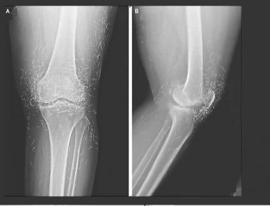 Οστεοαρθρίτιδα: Το σύμπτωμα που προμηνύει την εμφάνισή της